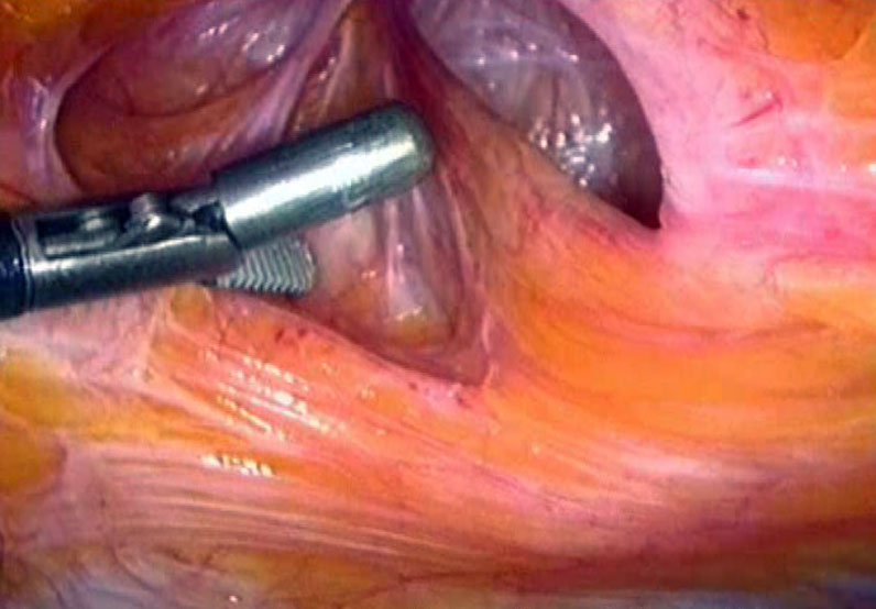 Intervento Ernia inguinale in laparoscopia - Testimonianza diretta